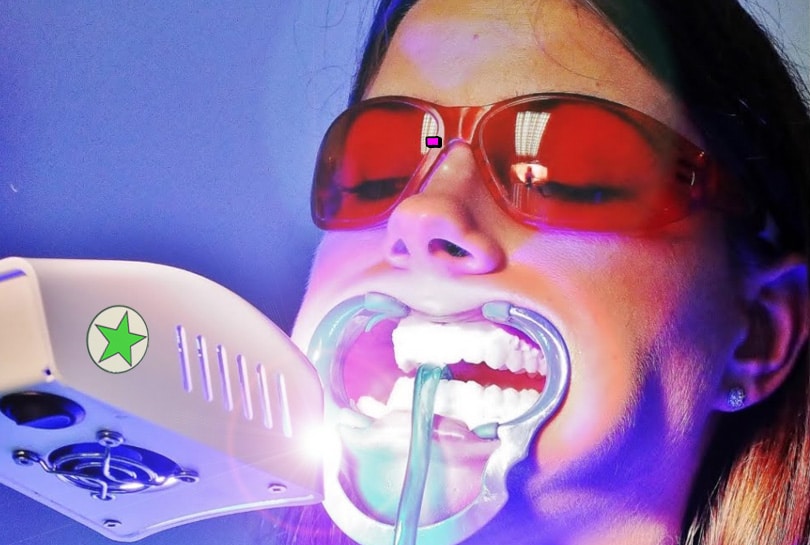 lasersko izbeljivanje zuba