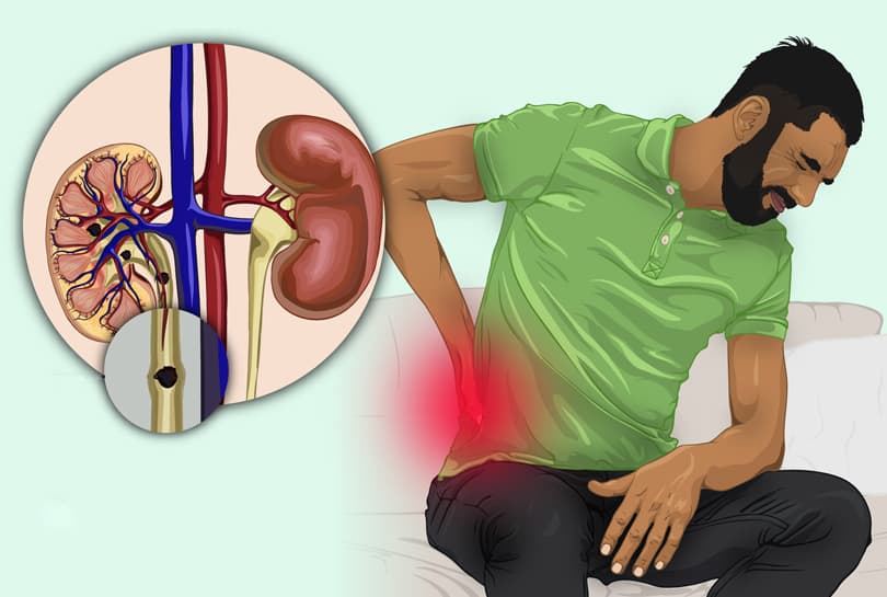 Featured image for “Simptomi kamen u bubregu 🚑 Šta topi kamen u bubregu”