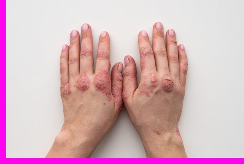 Sve što treba da znate o psorijazi i lečenju 3 psorijaza dijagnoza slika
