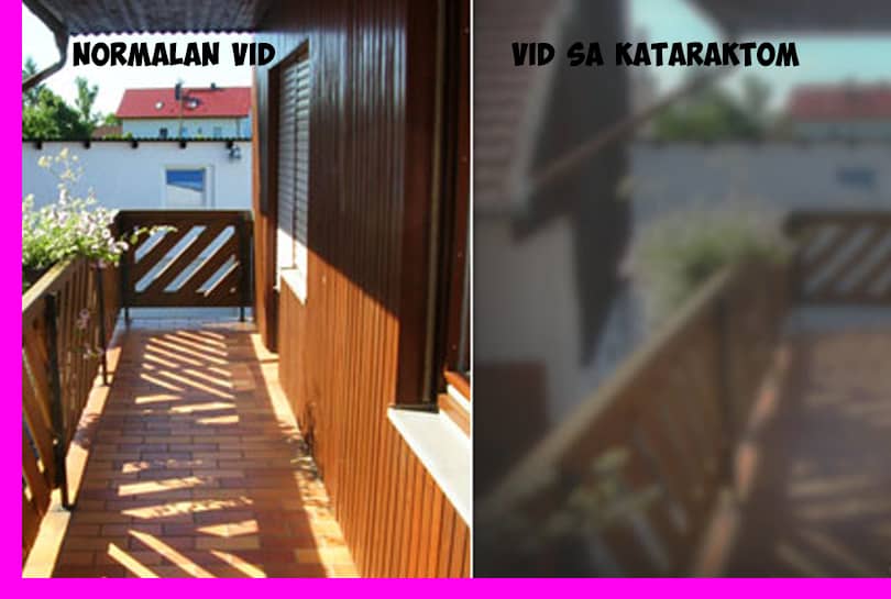 7 najčešćih Simptoma Katarakte 5 katarakta simptomi slike